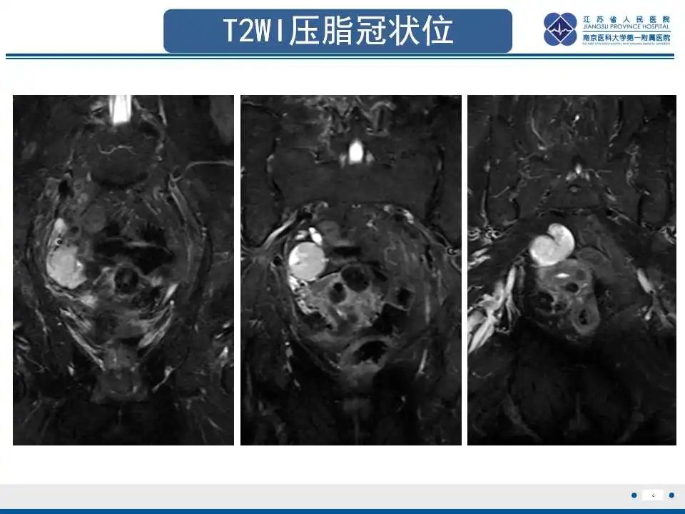 影像PPT - 【PPT】原发性输卵管癌-1