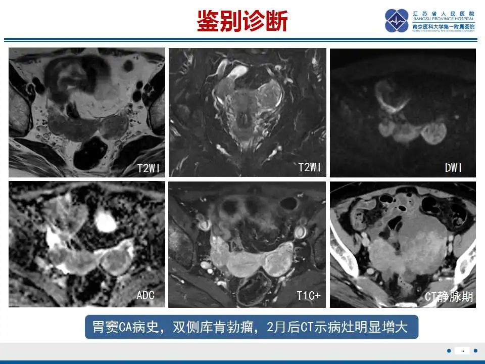 影像PPT - 【PPT】原发性输卵管癌-2