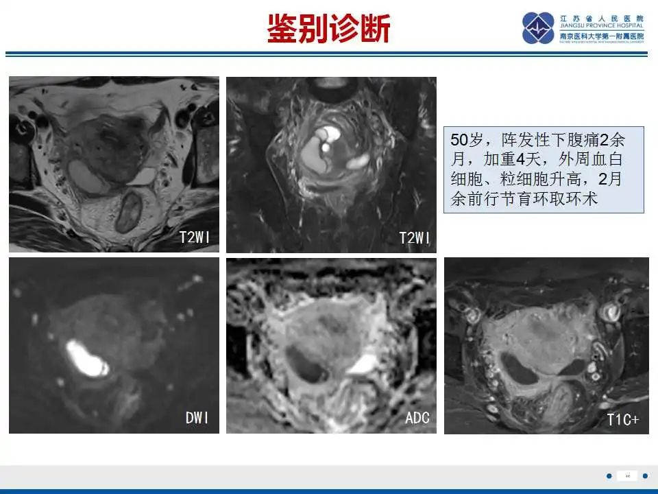 影像PPT - 【PPT】原发性输卵管癌-3