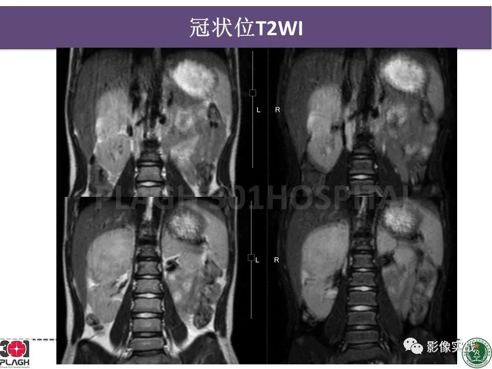 影像PPT - 【病例】节细胞神经母细胞瘤1例CT解析思路-6