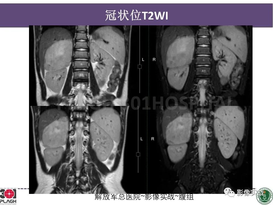 影像PPT - 【病例】节细胞神经母细胞瘤1例CT解析思路-7