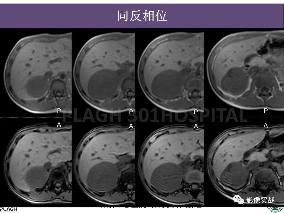 影像PPT - 【病例】节细胞神经母细胞瘤1例CT解析思路-8