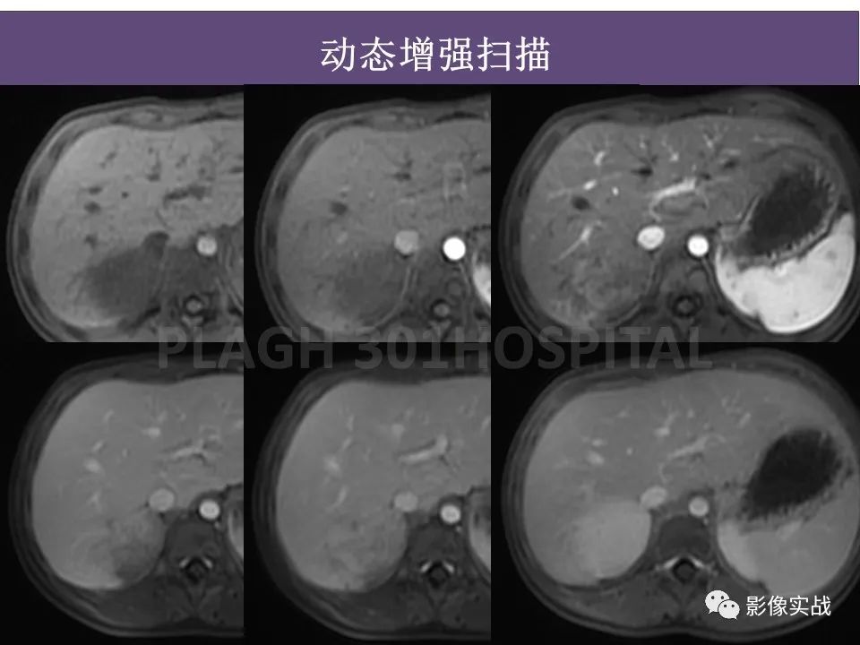 影像PPT - 【病例】节细胞神经母细胞瘤1例CT解析思路-11