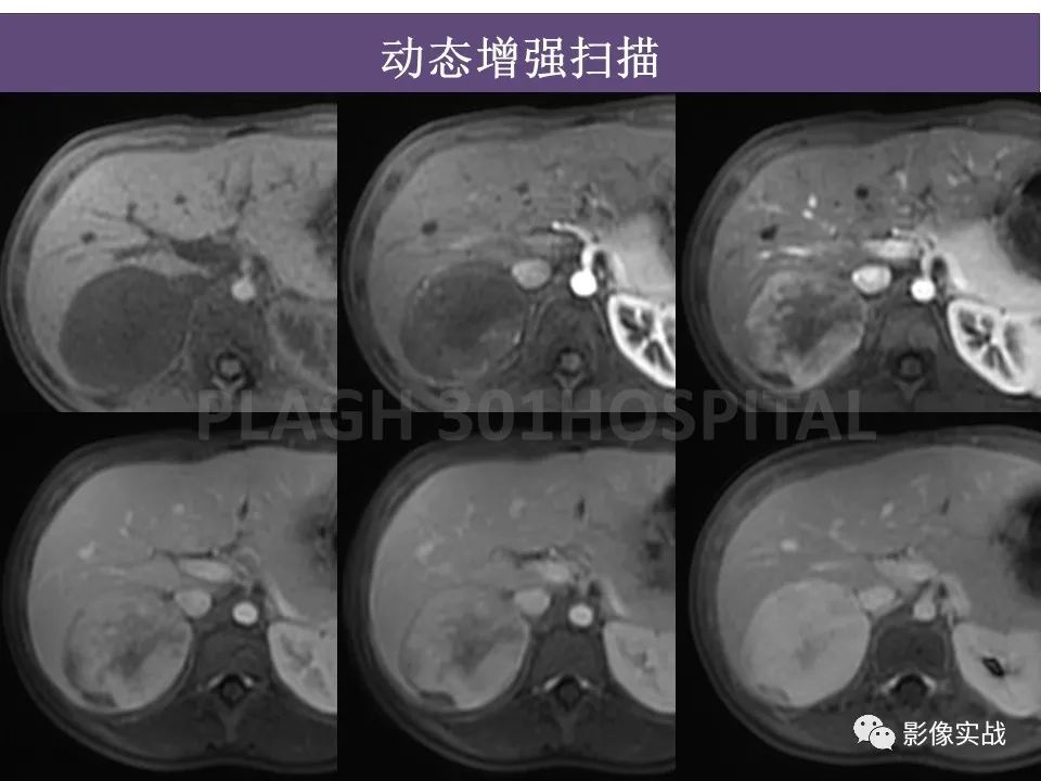 影像PPT - 【病例】节细胞神经母细胞瘤1例CT解析思路-12