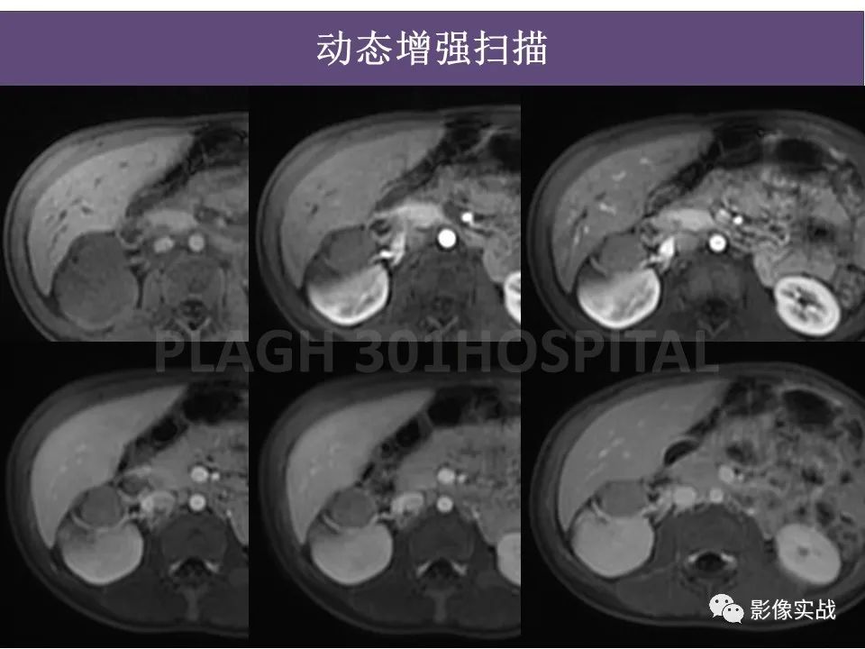 影像PPT - 【病例】节细胞神经母细胞瘤1例CT解析思路-14