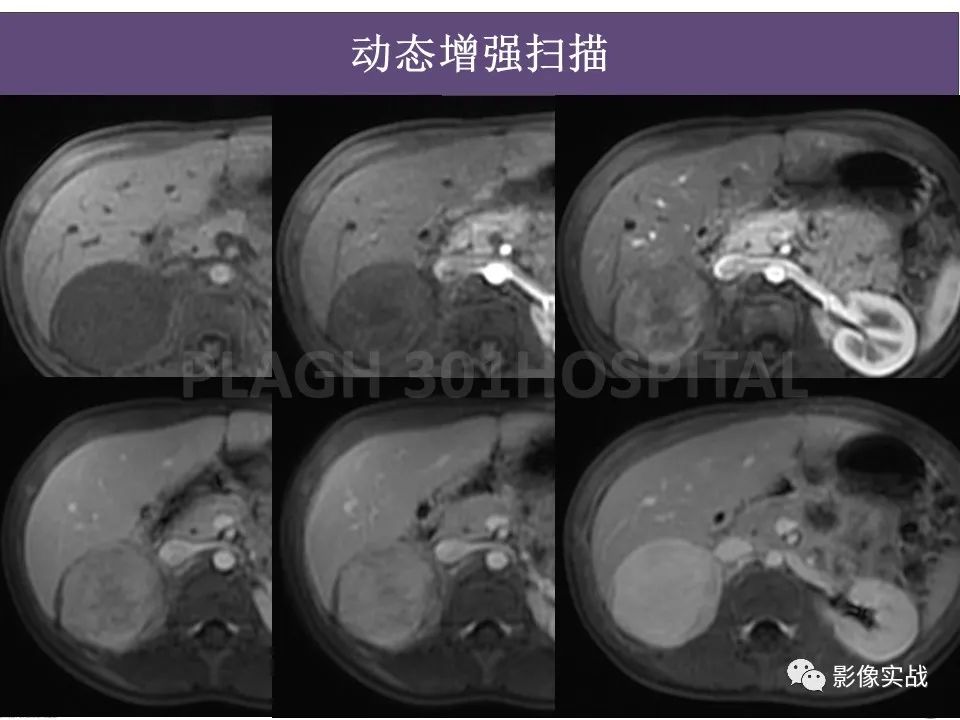 影像PPT - 【病例】节细胞神经母细胞瘤1例CT解析思路-13