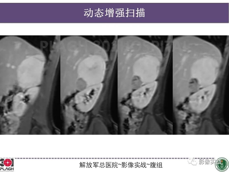 影像PPT - 【病例】节细胞神经母细胞瘤1例CT解析思路-15
