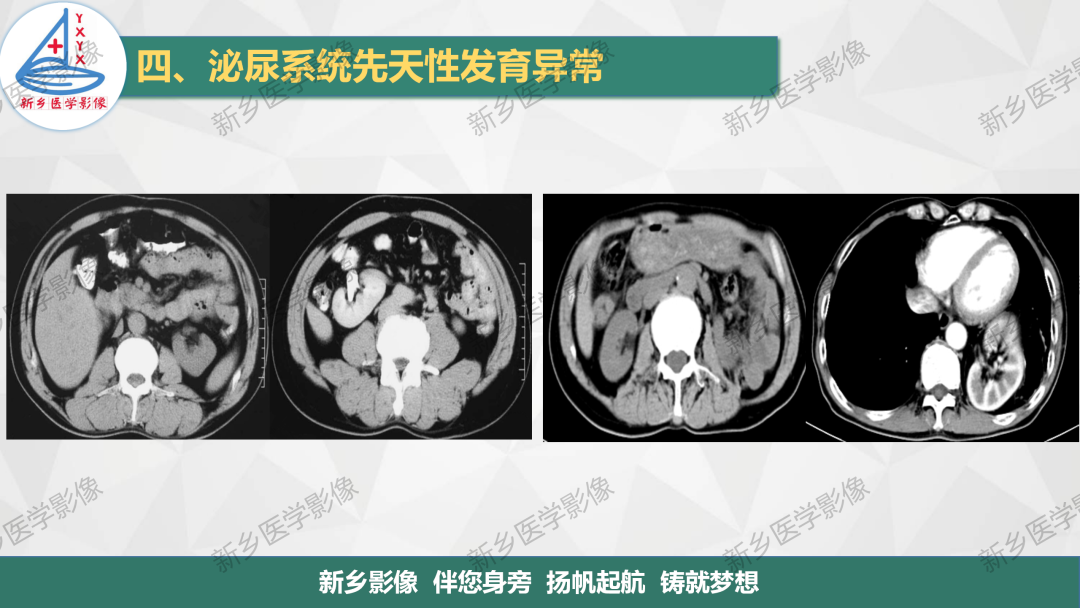 影像PPT - 【PPT】泌尿系统先天性发育异常影像表现-8