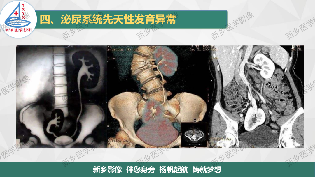 影像PPT - 【PPT】泌尿系统先天性发育异常影像表现-7