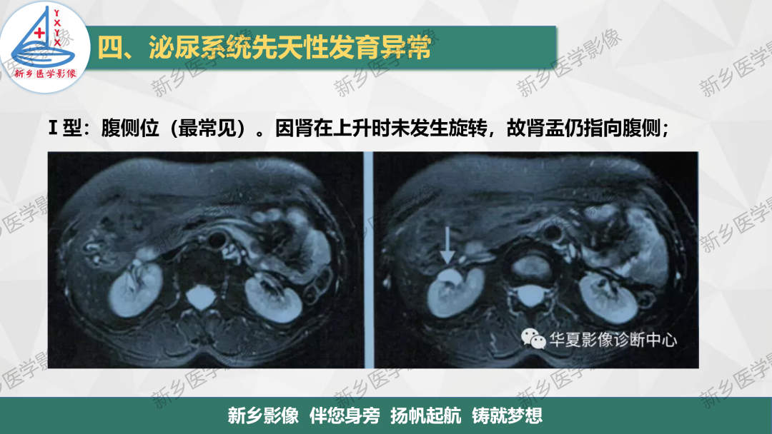 影像PPT - 【PPT】泌尿系统先天性发育异常影像表现-12