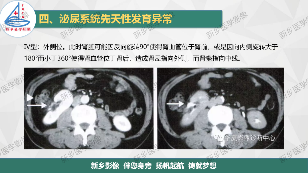 影像PPT - 【PPT】泌尿系统先天性发育异常影像表现-15