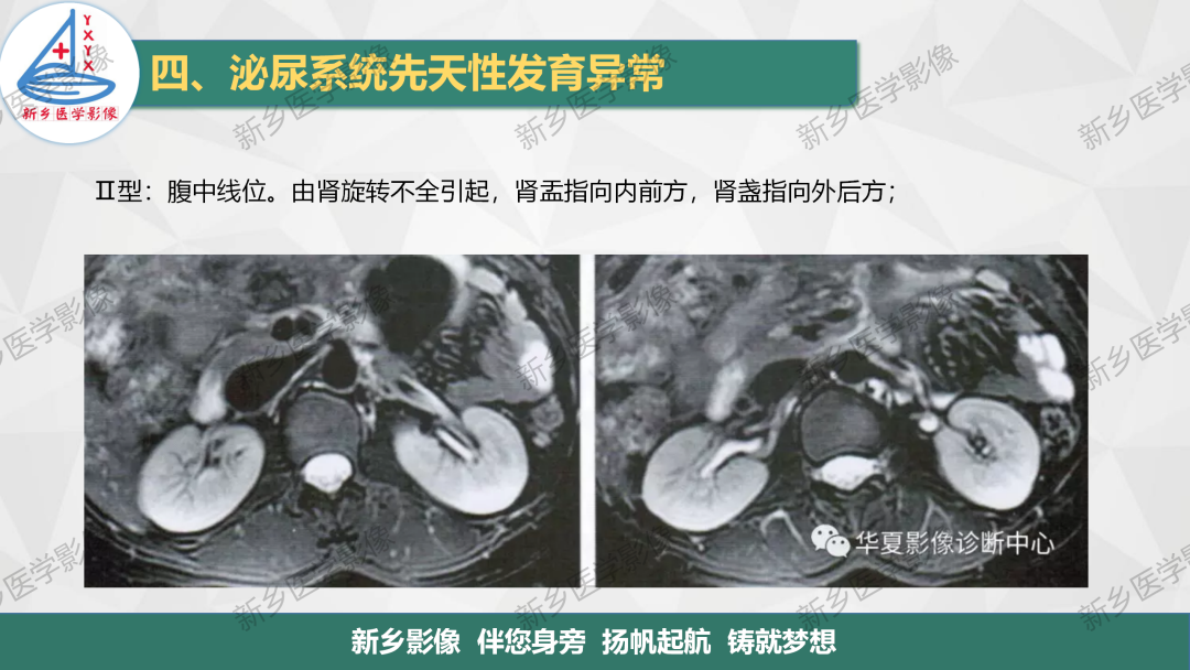 影像PPT - 【PPT】泌尿系统先天性发育异常影像表现-13