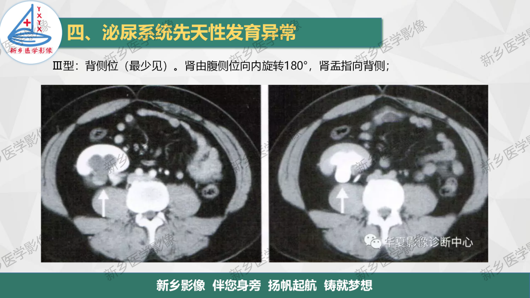 影像PPT - 【PPT】泌尿系统先天性发育异常影像表现-14