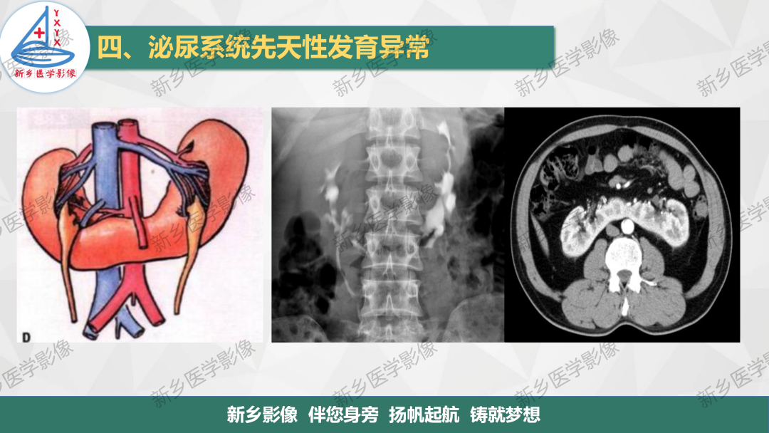 影像PPT - 【PPT】泌尿系统先天性发育异常影像表现-17