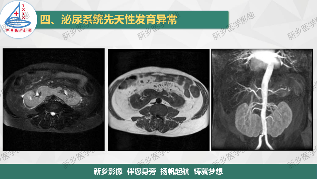 影像PPT - 【PPT】泌尿系统先天性发育异常影像表现-18