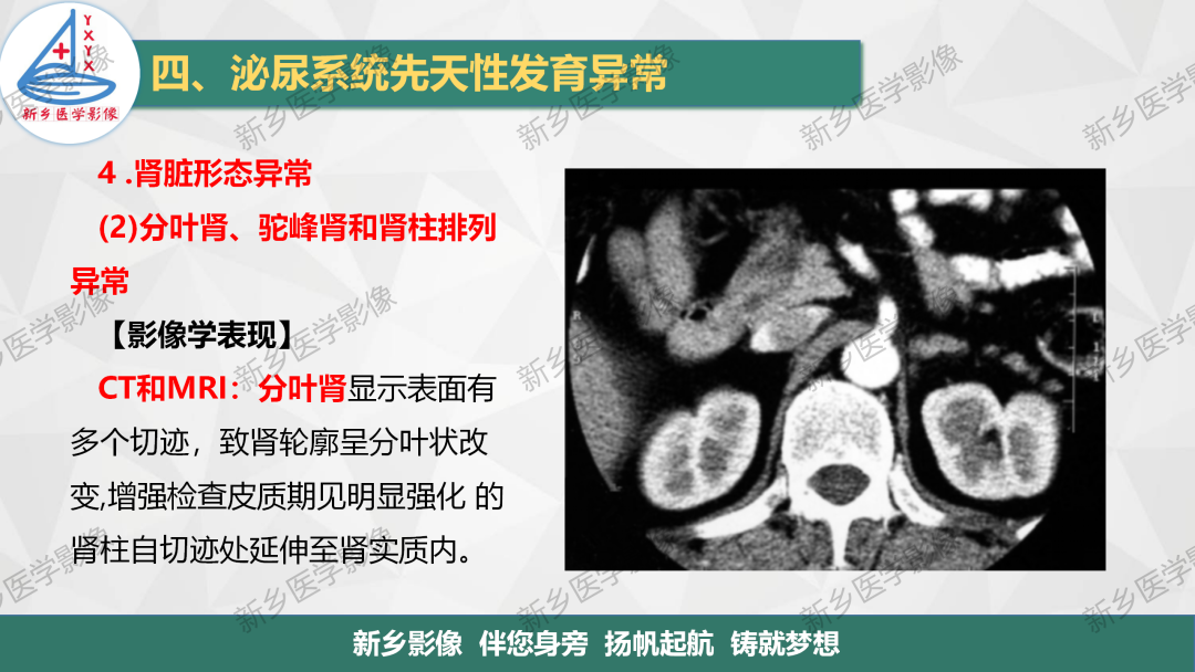 影像PPT - 【PPT】泌尿系统先天性发育异常影像表现-20