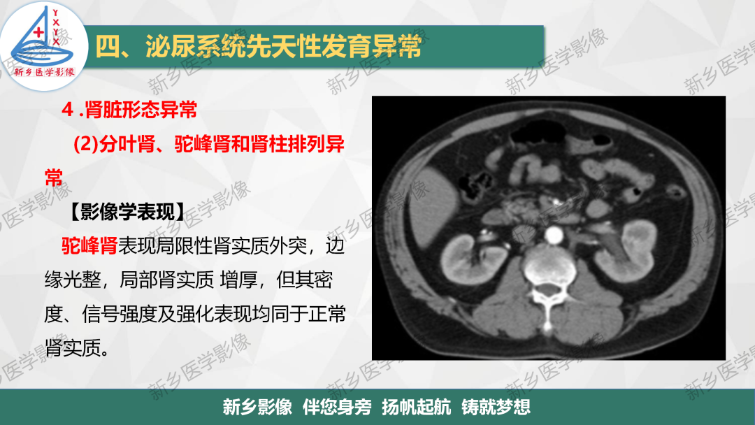 影像PPT - 【PPT】泌尿系统先天性发育异常影像表现-21