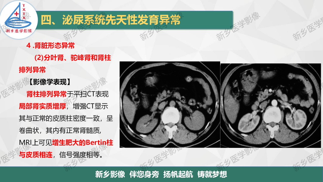 影像PPT - 【PPT】泌尿系统先天性发育异常影像表现-22