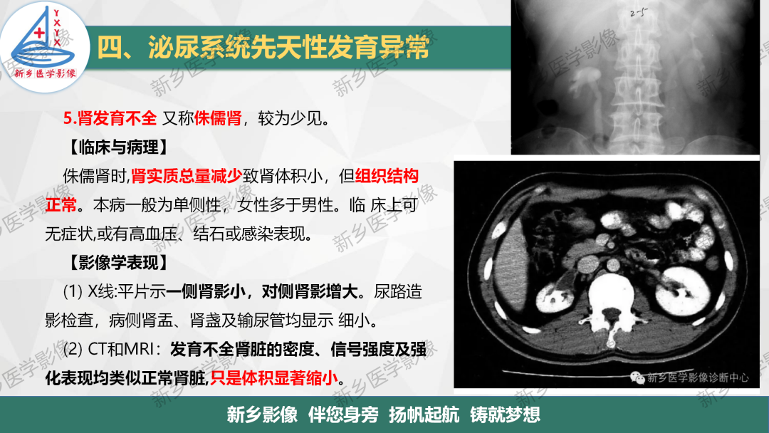 影像PPT - 【PPT】泌尿系统先天性发育异常影像表现-23