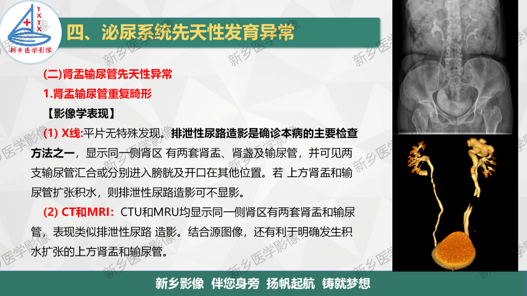 影像PPT - 【PPT】泌尿系统先天性发育异常影像表现-25
