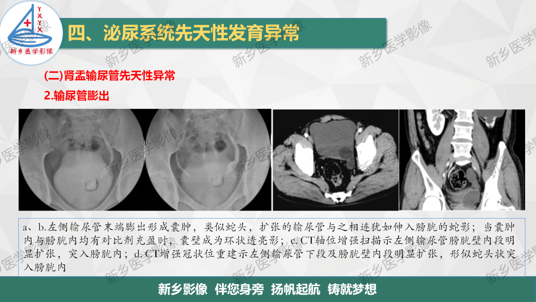 影像PPT - 【PPT】泌尿系统先天性发育异常影像表现-27