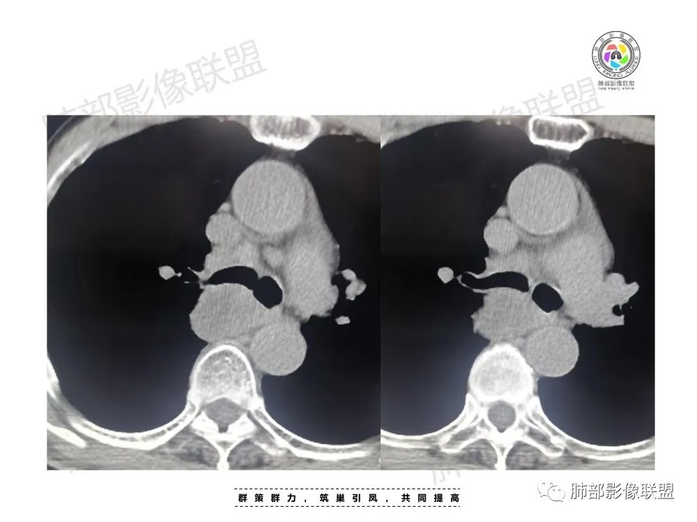 影像PPT - 【病例】肺肉瘤样癌1例CT-6 影像PPT - 【病例】肺肉瘤样癌1例CT-6