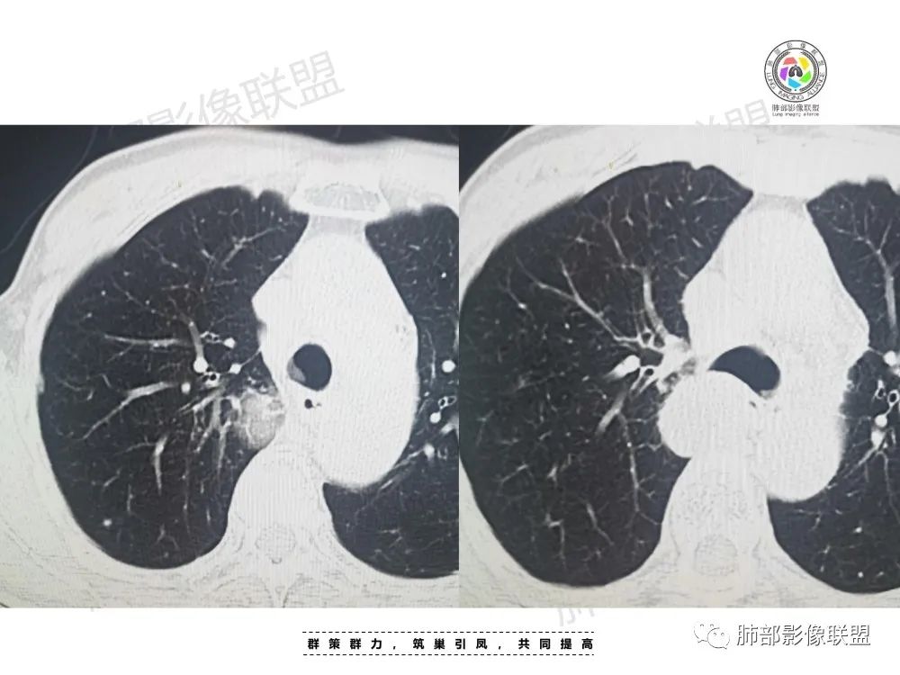 影像PPT - 【病例】肺肉瘤样癌1例CT-3 影像PPT - 【病例】肺肉瘤样癌1例CT-3