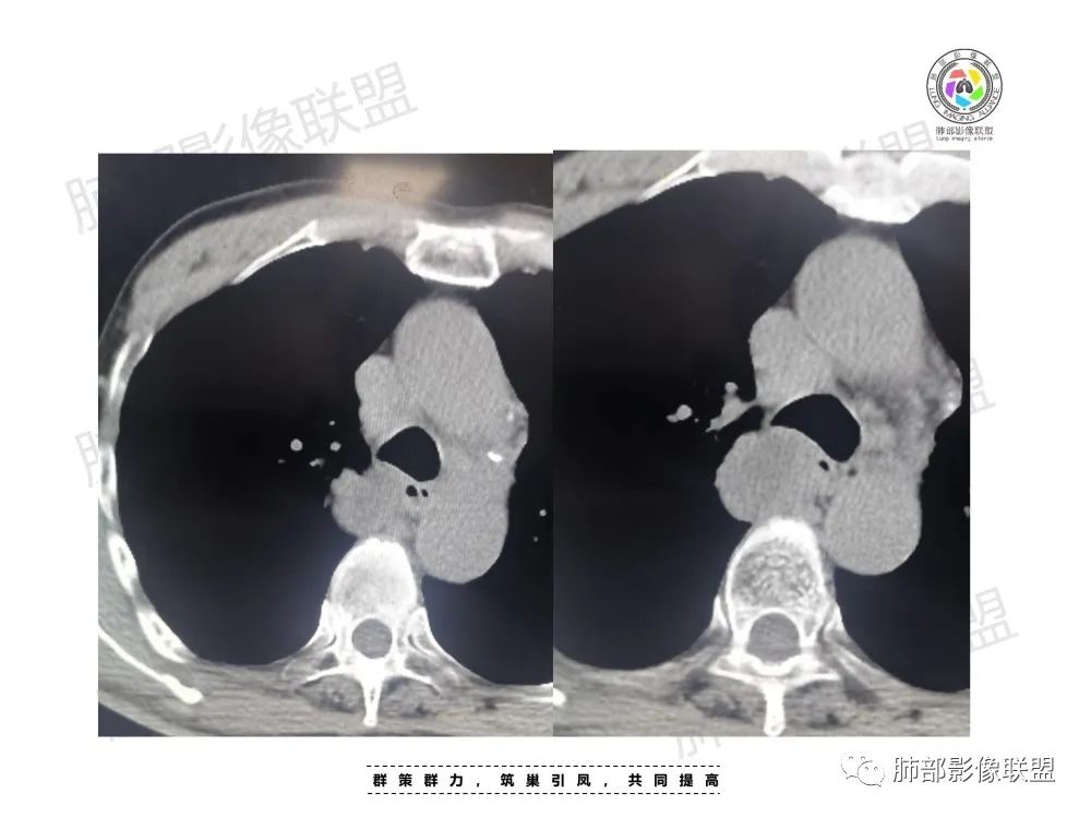 影像PPT - 【病例】肺肉瘤样癌1例CT-5 影像PPT - 【病例】肺肉瘤样癌1例CT-5