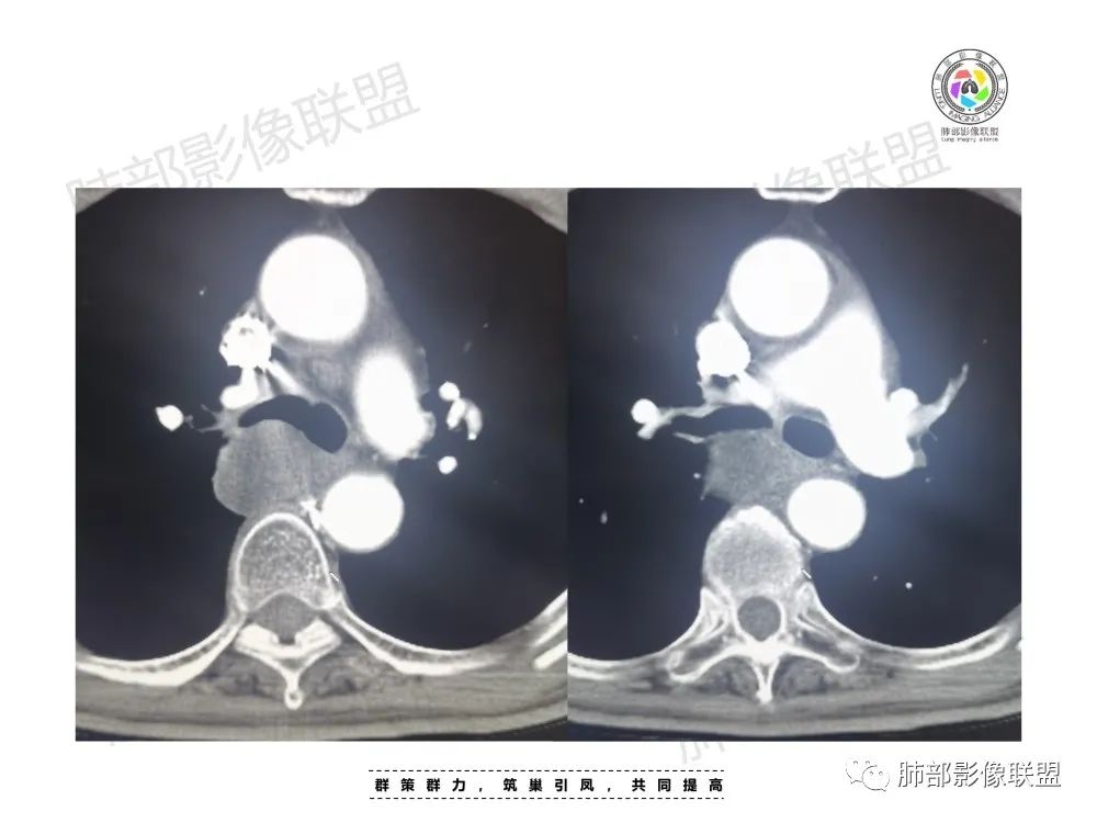 影像PPT - 【病例】肺肉瘤样癌1例CT-7 影像PPT - 【病例】肺肉瘤样癌1例CT-7