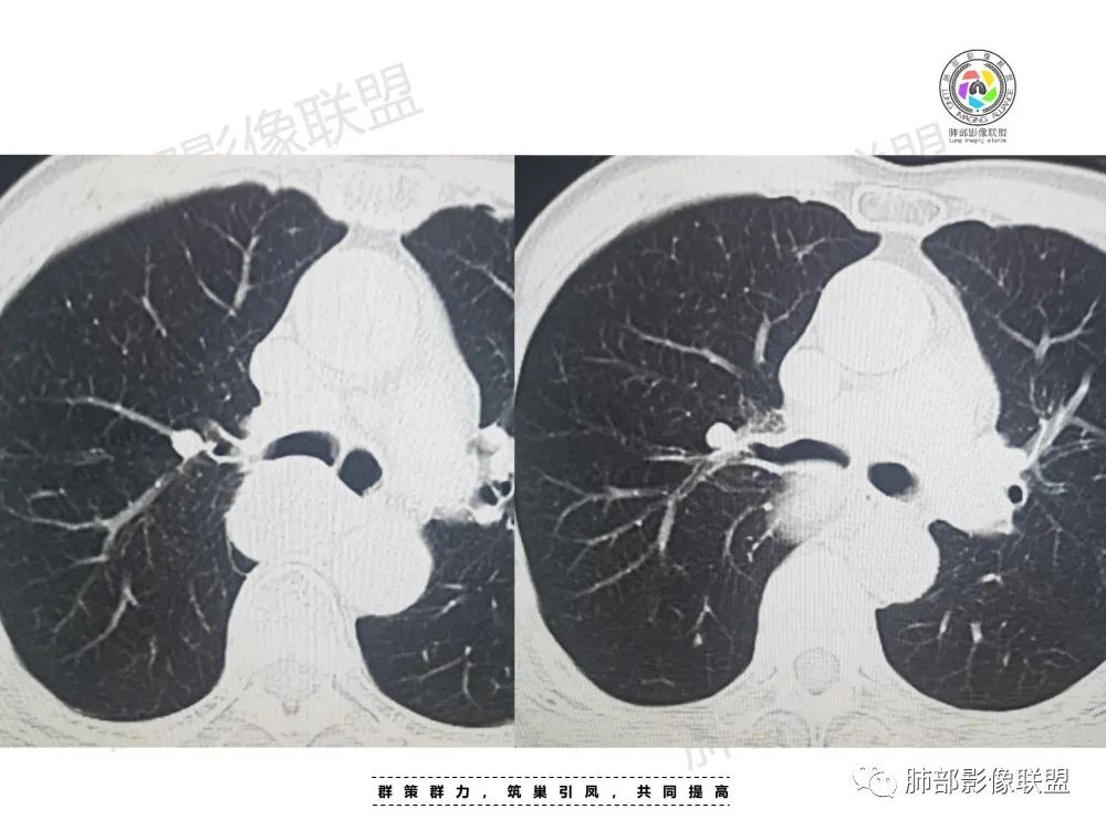 影像PPT - 【病例】肺肉瘤样癌1例CT-4 影像PPT - 【病例】肺肉瘤样癌1例CT-4