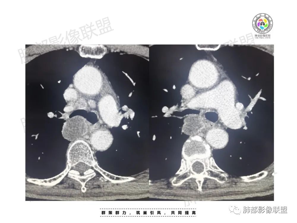 影像PPT - 【病例】肺肉瘤样癌1例CT-8 影像PPT - 【病例】肺肉瘤样癌1例CT-8