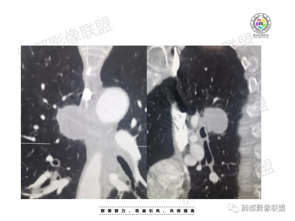 影像PPT - 【病例】肺肉瘤样癌1例CT-10 影像PPT - 【病例】肺肉瘤样癌1例CT-10