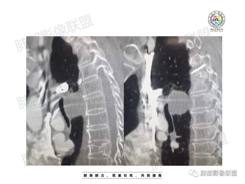 影像PPT - 【病例】肺肉瘤样癌1例CT-11 影像PPT - 【病例】肺肉瘤样癌1例CT-11