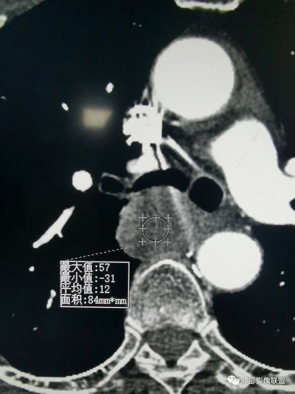 影像PPT - 【病例】肺肉瘤样癌1例CT-13 影像PPT - 【病例】肺肉瘤样癌1例CT-13