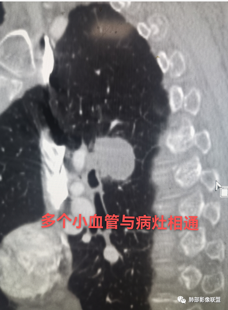 影像PPT - 【病例】肺肉瘤样癌1例CT-22 影像PPT - 【病例】肺肉瘤样癌1例CT-22