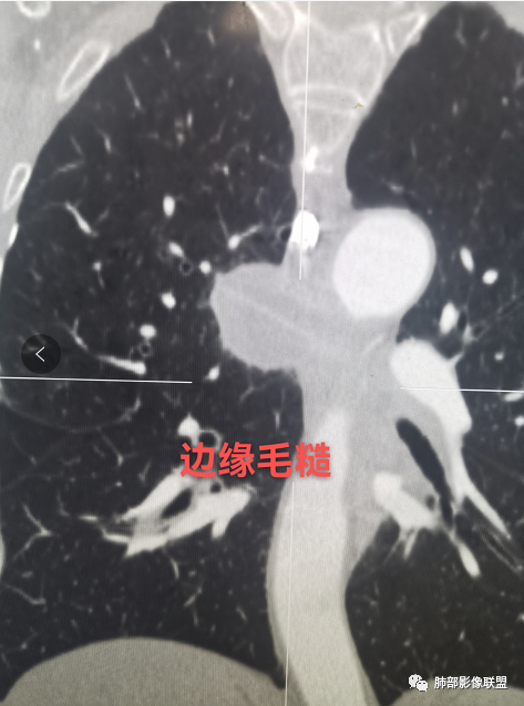 影像PPT - 【病例】肺肉瘤样癌1例CT-21 影像PPT - 【病例】肺肉瘤样癌1例CT-21
