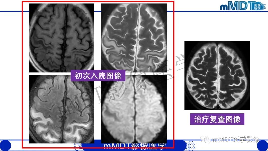 影像PPT - 【病例】铅中毒性脑病1例MR病例赏析-2 影像PPT - 【病例】铅中毒性脑病1例MR病例赏析-2