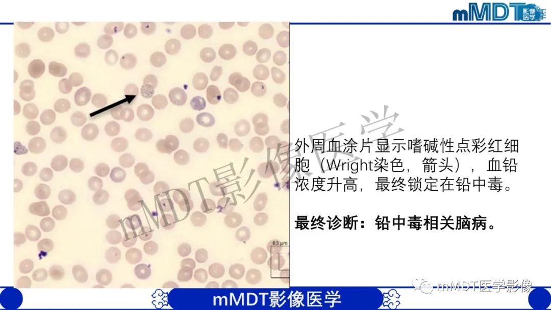 影像PPT - 【病例】铅中毒性脑病1例MR病例赏析-6 影像PPT - 【病例】铅中毒性脑病1例MR病例赏析-6