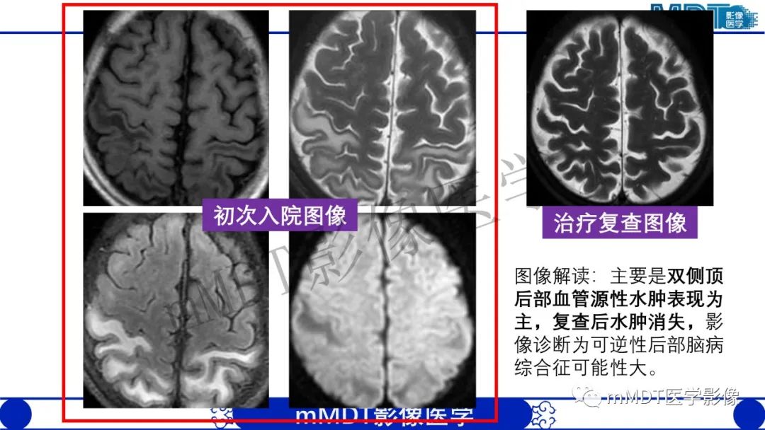 影像PPT - 【病例】铅中毒性脑病1例MR病例赏析-4 影像PPT - 【病例】铅中毒性脑病1例MR病例赏析-4