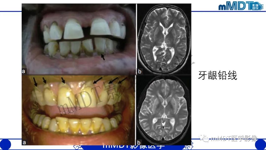 影像PPT - 【病例】铅中毒性脑病1例MR病例赏析-8 影像PPT - 【病例】铅中毒性脑病1例MR病例赏析-8