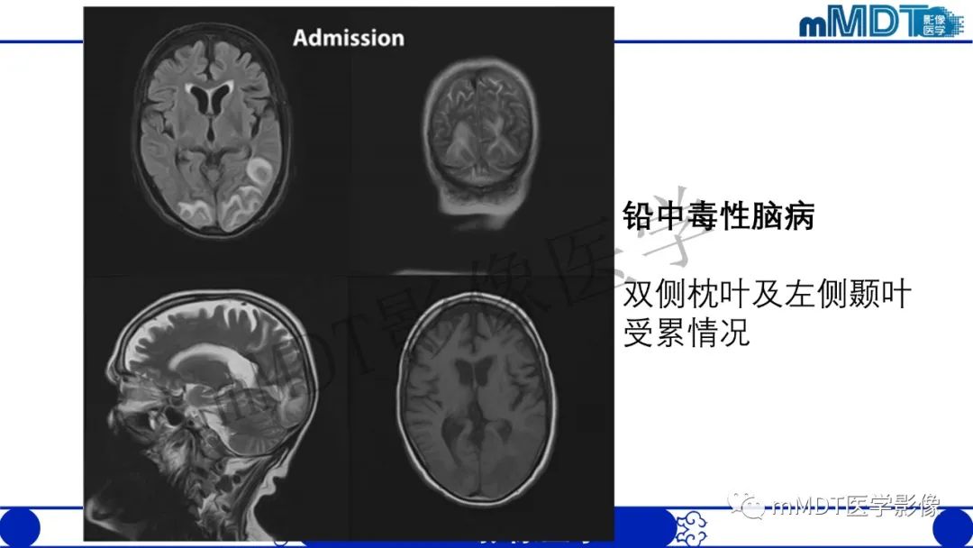 影像PPT - 【病例】铅中毒性脑病1例MR病例赏析-10 影像PPT - 【病例】铅中毒性脑病1例MR病例赏析-10
