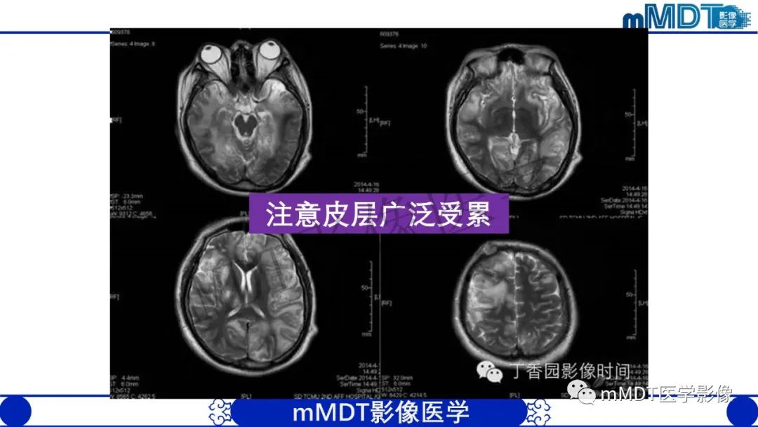 影像PPT - 【病例】铅中毒性脑病1例MR病例赏析-14 影像PPT - 【病例】铅中毒性脑病1例MR病例赏析-14