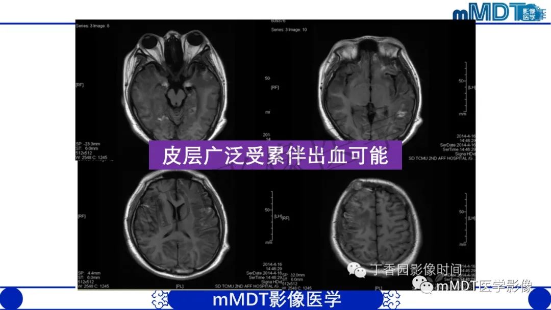 影像PPT - 【病例】铅中毒性脑病1例MR病例赏析-16 影像PPT - 【病例】铅中毒性脑病1例MR病例赏析-16
