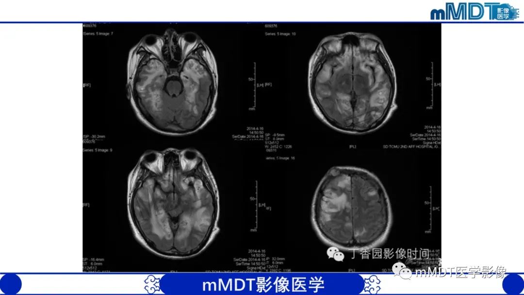 影像PPT - 【病例】铅中毒性脑病1例MR病例赏析-15 影像PPT - 【病例】铅中毒性脑病1例MR病例赏析-15