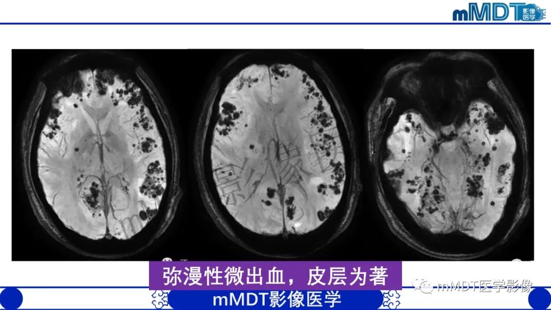 影像PPT - 【病例】铅中毒性脑病1例MR病例赏析-17 影像PPT - 【病例】铅中毒性脑病1例MR病例赏析-17