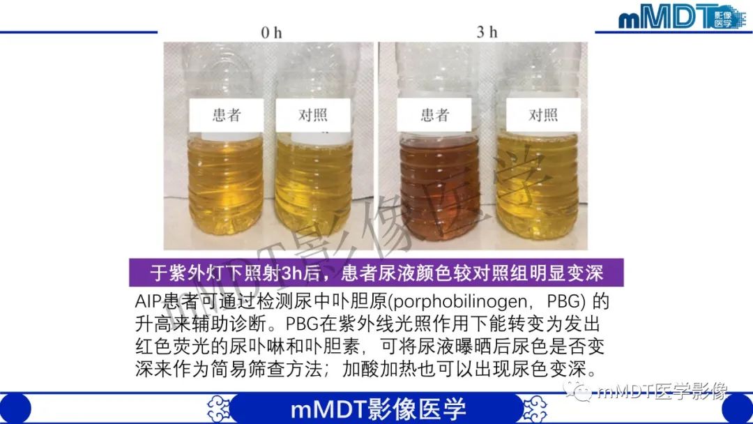 影像PPT - 【病例】铅中毒性脑病1例MR病例赏析-19 影像PPT - 【病例】铅中毒性脑病1例MR病例赏析-19