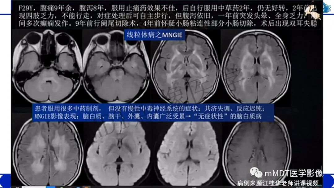 影像PPT - 【病例】铅中毒性脑病1例MR病例赏析-23 影像PPT - 【病例】铅中毒性脑病1例MR病例赏析-23
