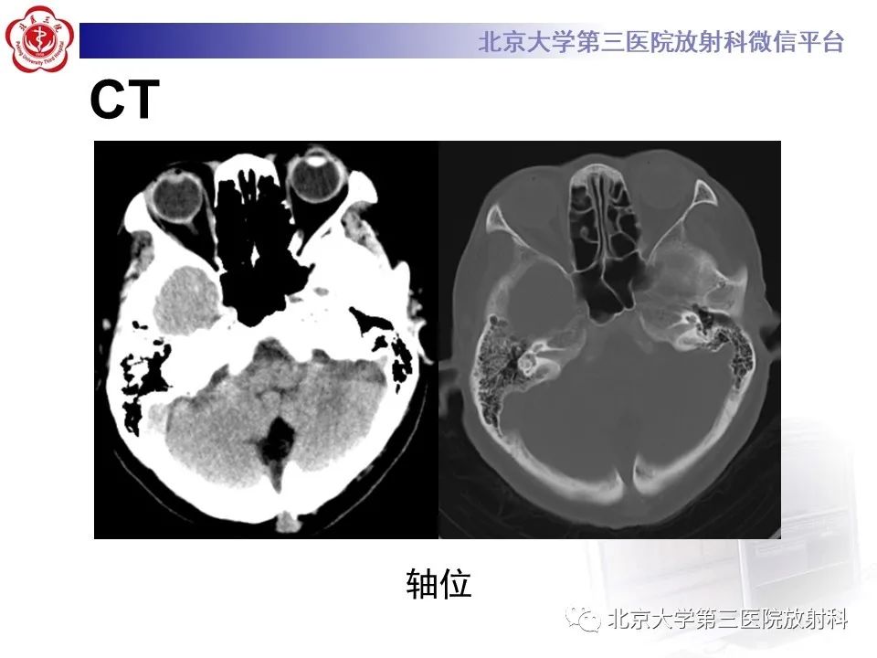 影像PPT - 【PPT】(颅内)皮样囊肿-3