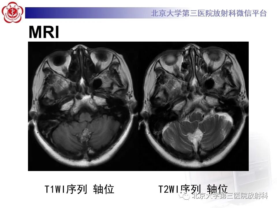影像PPT - 【PPT】(颅内)皮样囊肿-4