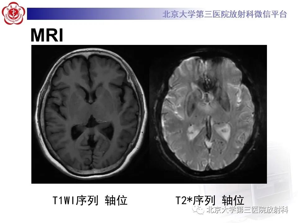 影像PPT - 【PPT】(颅内)皮样囊肿-5